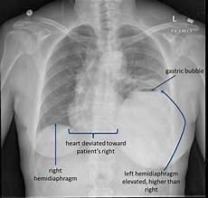 Diaphragm